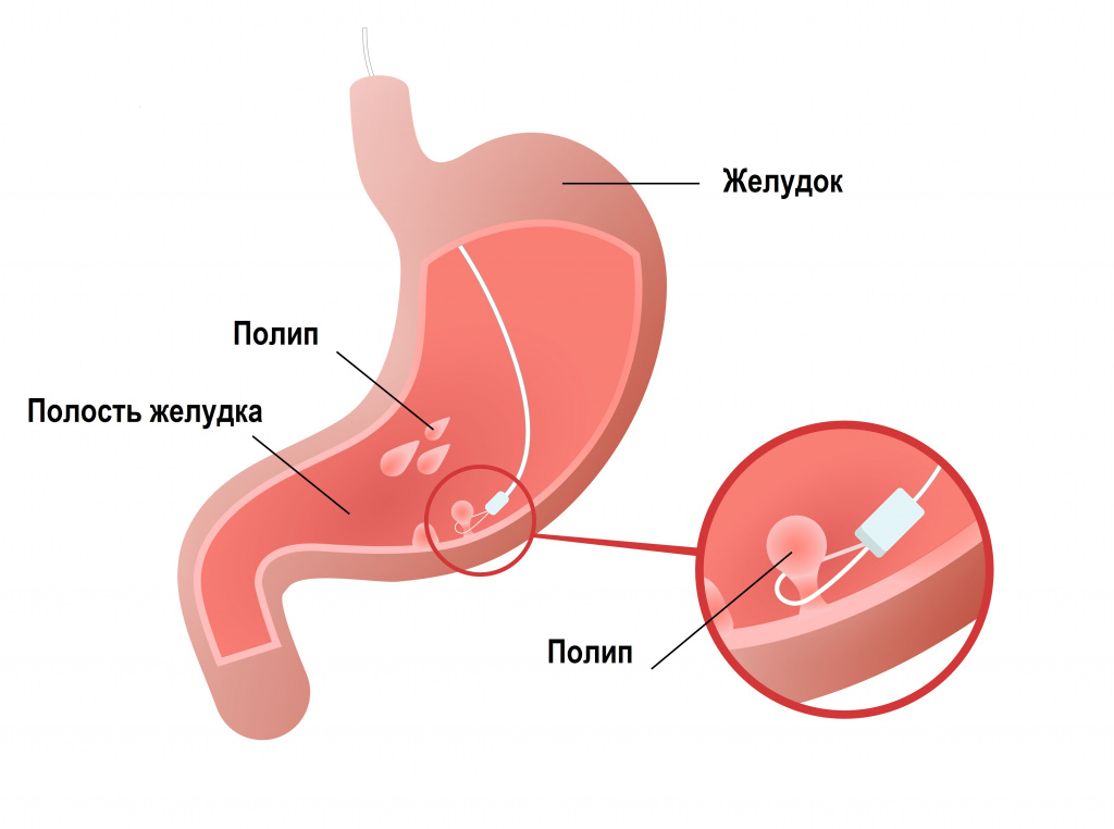 Полипы в желудке